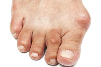 bunions treatment in the Jupiter, FL 33458 area