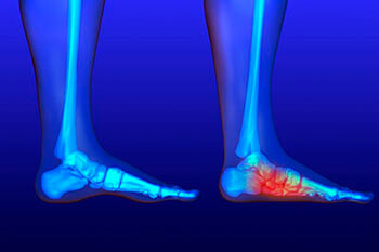Flat feet and Fallen Arches treatment in the Jupiter, FL 33458 area