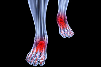 arthritic foot and ankle care treatment in the Jupiter, FL 33458 area
