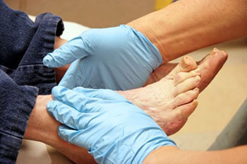 diabetic foot treatment in the Jupiter, FL 33458 area