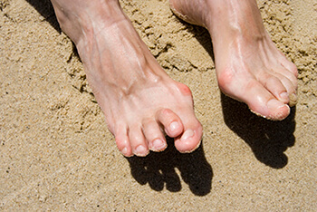 hammertoes treatment in the Jupiter, FL 33458 area