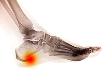 Heel spurs treatment in the Jupiter, FL 33458 area