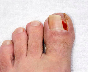 Ingrown toenails treatment in the Jupiter, FL 33458 area