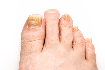 fungus toenails treatment in the Jupiter, FL 33458 area