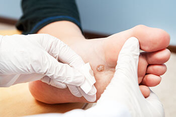 Plantar warts treatment in the Jupiter, FL 33458 area