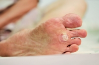 What Does a Plantar Wart Look Like?