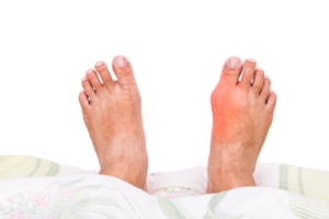 What Is Gout?