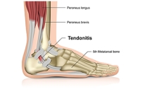 Older People and Achilles Tendonitis