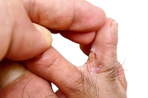 How to Prevent Athlete’s Foot