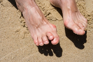 How Different Types of Arthritis Can Affect the Feet