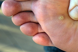 Are Plantar Warts Contagious?