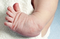 Clubfoot Treatment Starts After the Baby Is Born