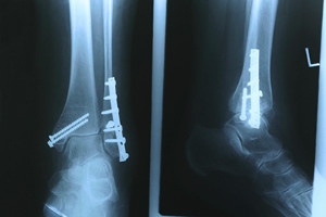 What Can Cause a Stress Fracture?