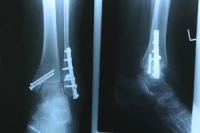 What Can Cause a Stress Fracture?