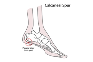 How Can I Prevent Heel Spurs?