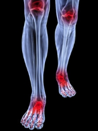 Rheumatoid Arthritis Is Associated With Many Foot Conditions