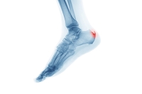 Causes, Symptoms, and Effective Solutions for Heel Spurs