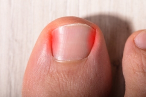 Ingrown Toenails Can Cause Pain