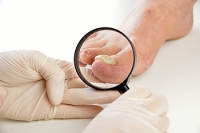 Signs You May Have a Fungal Toenail Infection