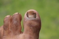 How the Right Shoes Help Prevent Toenail Fungus