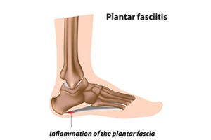 Understanding and Managing Plantar Fasciitis