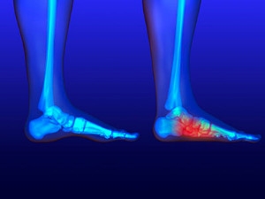 Pediatric Flat Feet