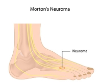 What Are the Symptoms of Morton’s Neuroma?